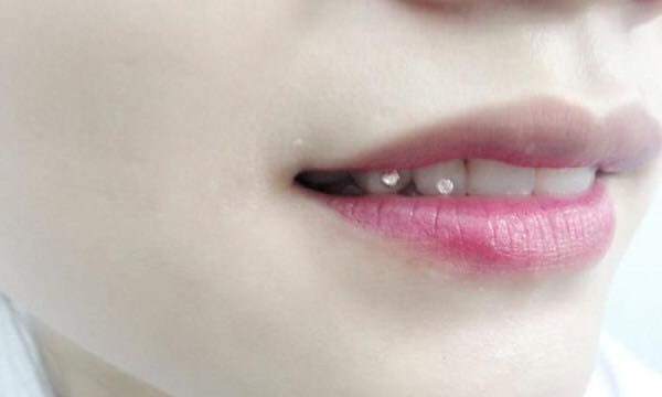 Đính đá trang điểm cho răng