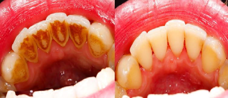 Cao răng là gì, tại sao phải lấy cao răng?