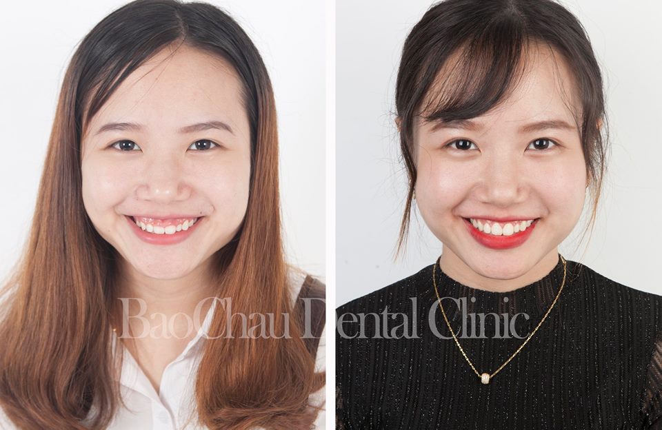 Phẫu thuật cười hở lợi 