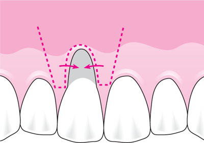HIỆN TƯỢNG BỊ TỤT LỢI CHÂN RĂNG PHẢI LÀM SAO ĐỂ ĐIỀU TRỊ?