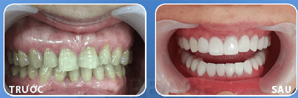 Phục Hình Răng Xỉn Màu 