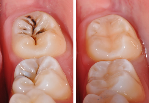SÂU RĂNG - NHỮNG ĐIỀU CẦN BIẾT!