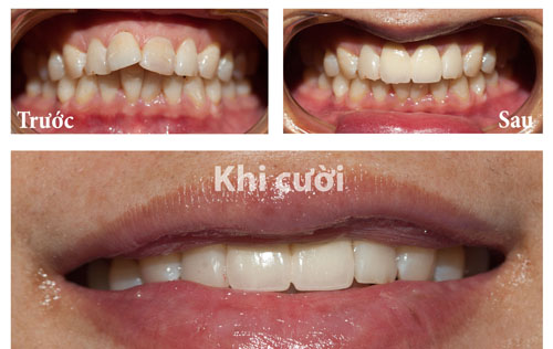 Răng sứ thẩm mỹ 